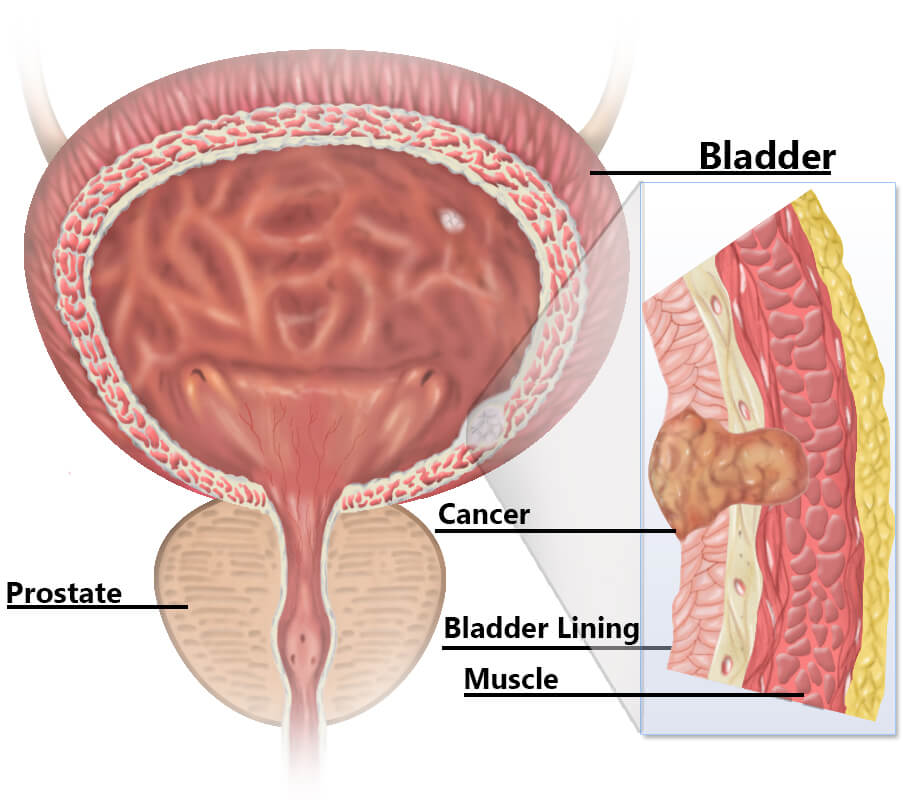 Bladder_Cancer_treatment