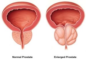 prostate enlargement treatment