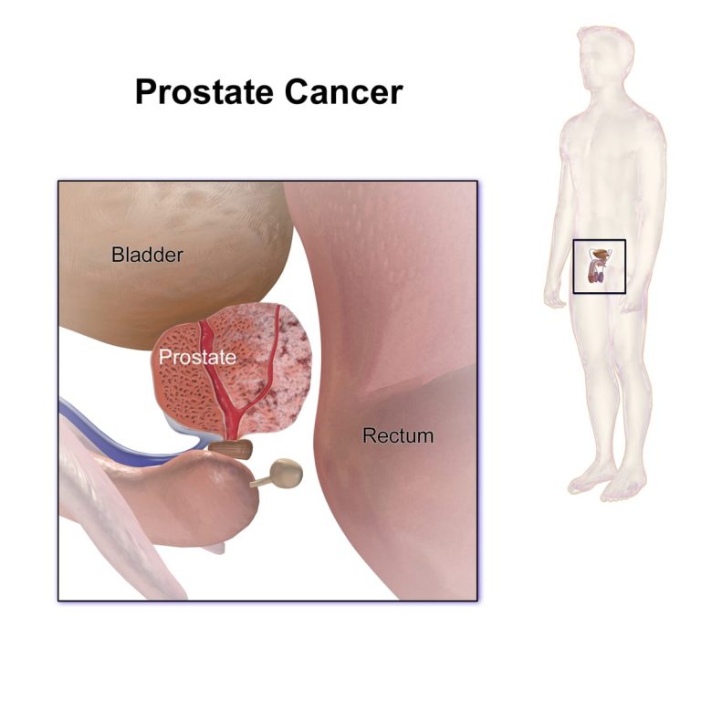 Prostate_Cancer_Treatment